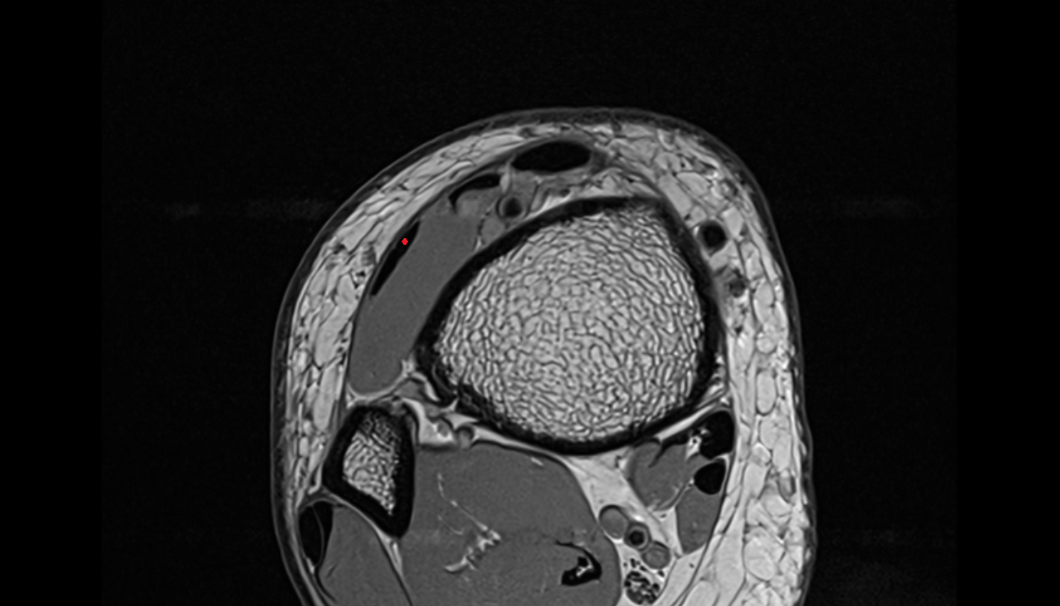 Extensor digitorum longus tendon  axial cross sectional anatomy 3T MRI AI enhanced radiology image-img-00000-00000