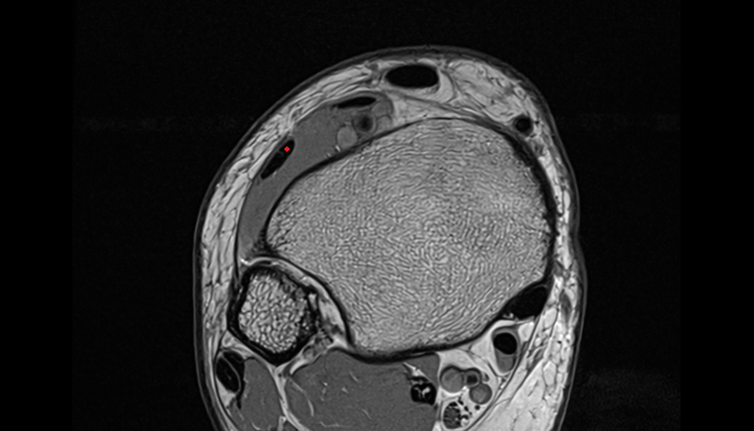 Extensor digitorum longus tendon  axial cross sectional anatomy 3T MRI AI enhanced radiology image-img-00000-00000_00001
