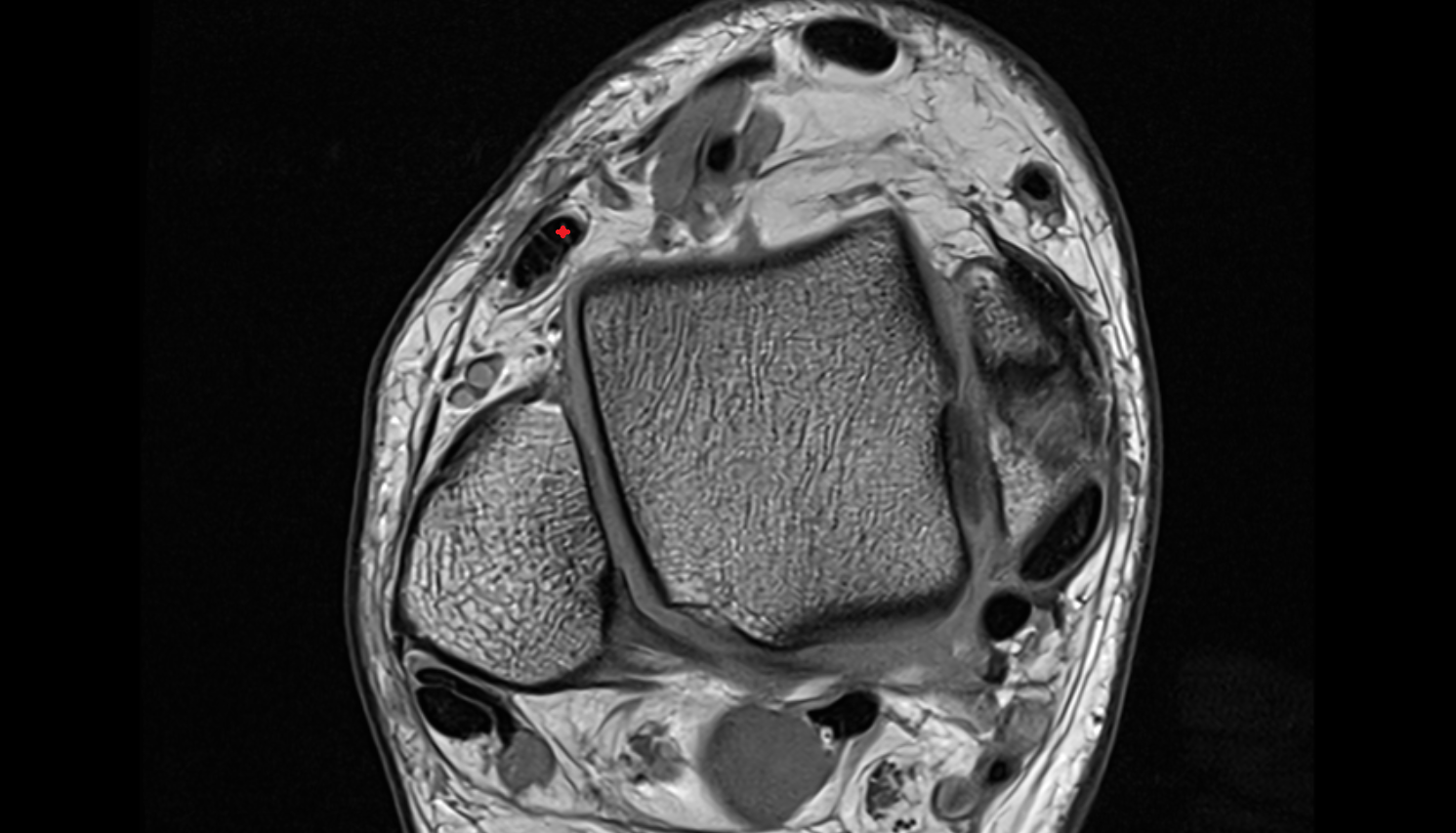 Extensor digitorum longus tendon  axial cross sectional anatomy 3T MRI AI enhanced radiology image-img-00000-00000_00002