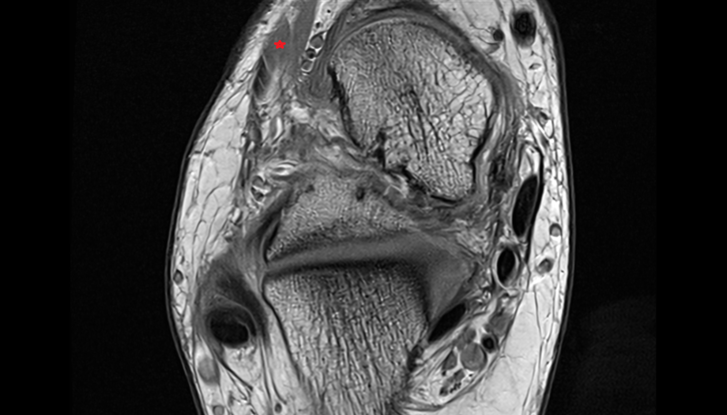 Extensor digitorum longus tendon  axial cross sectional anatomy 3T MRI AI enhanced radiology image-img-00000-00000_00003