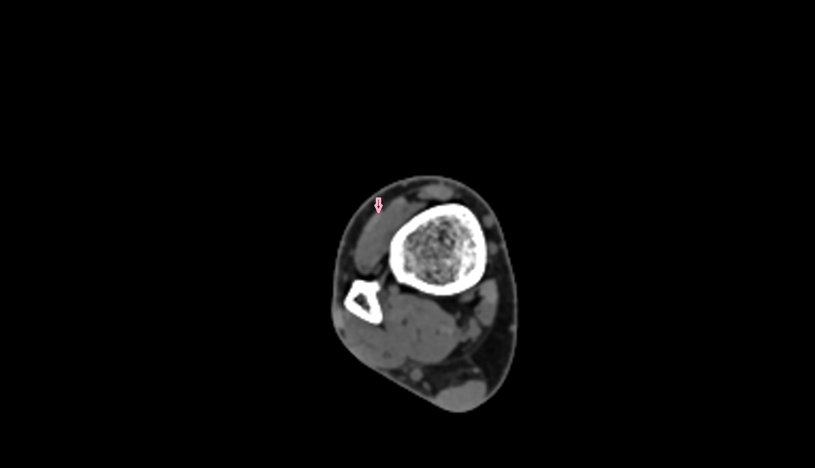 Extensor digitorum longus tendon ct axial  0