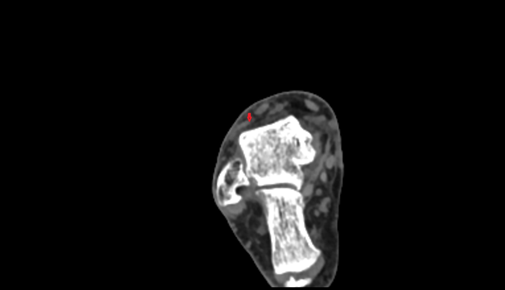 Extensor digitorum longus tendon ct axial  2