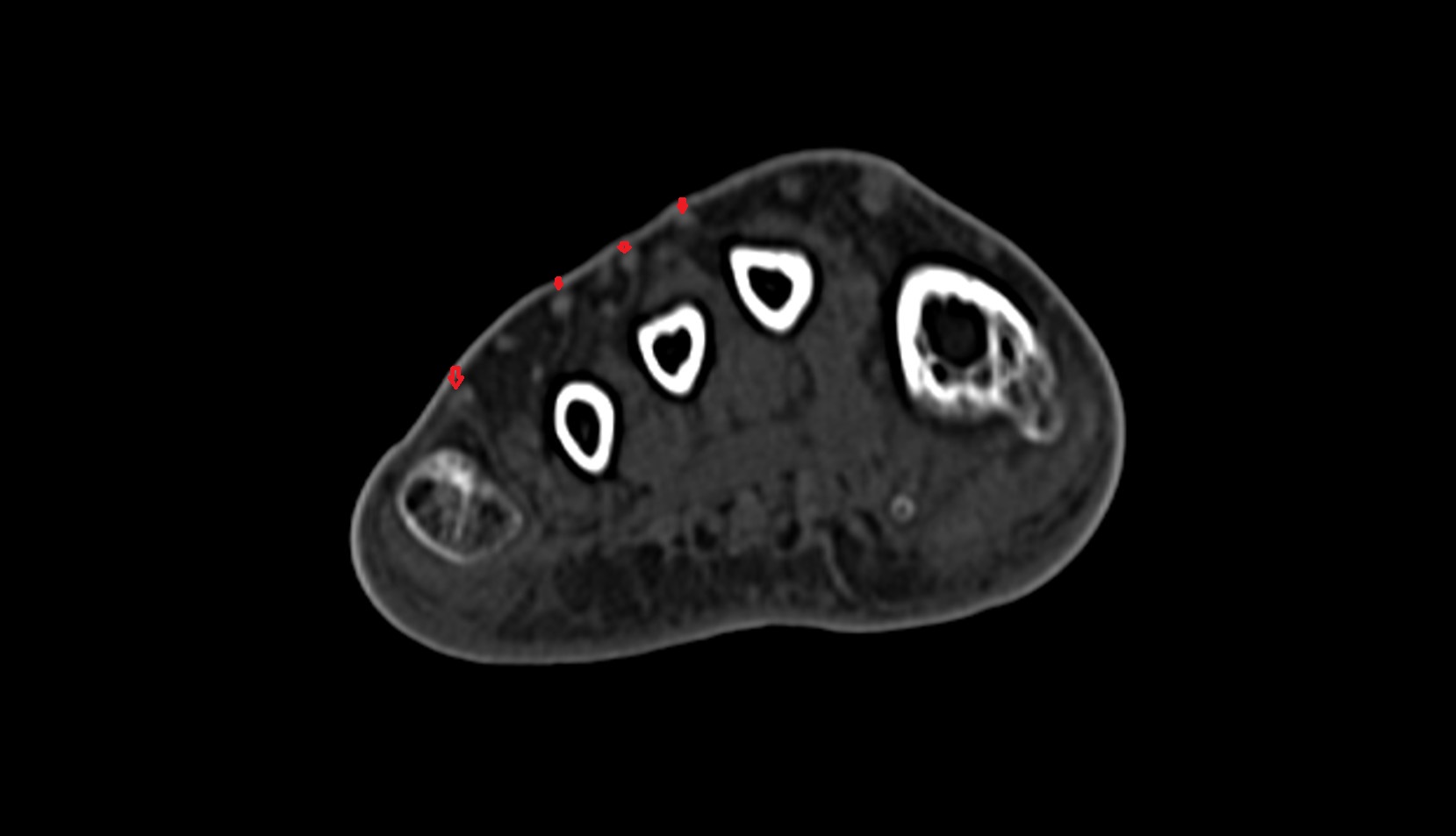 Extensor digitorum longus tendons ct axial image