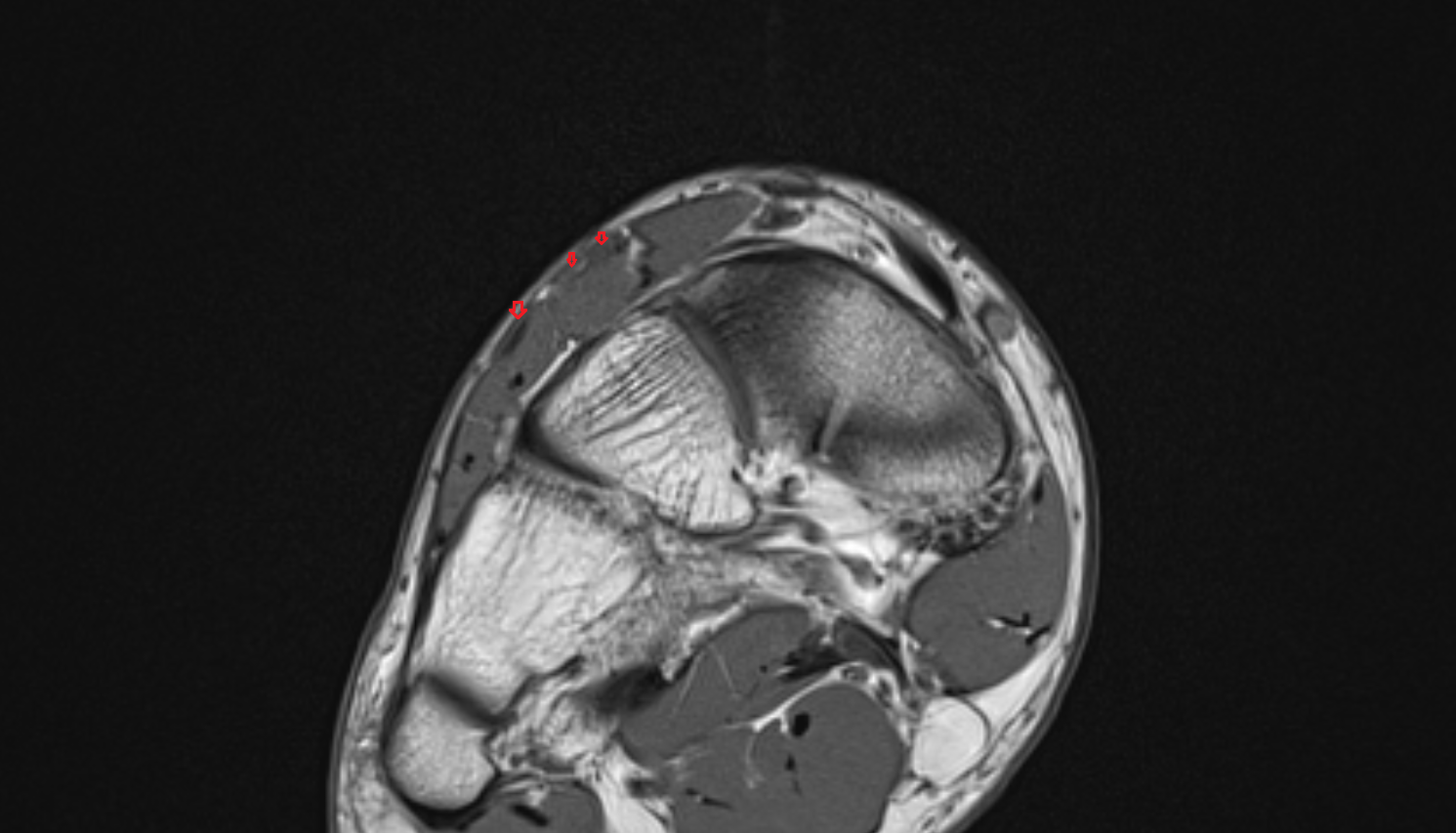 Extensor digitorum longus tendons  of the Foot  axial cross sectional anatomy 3T MRI AI enhanced radiology image-img-00000-00000_00001