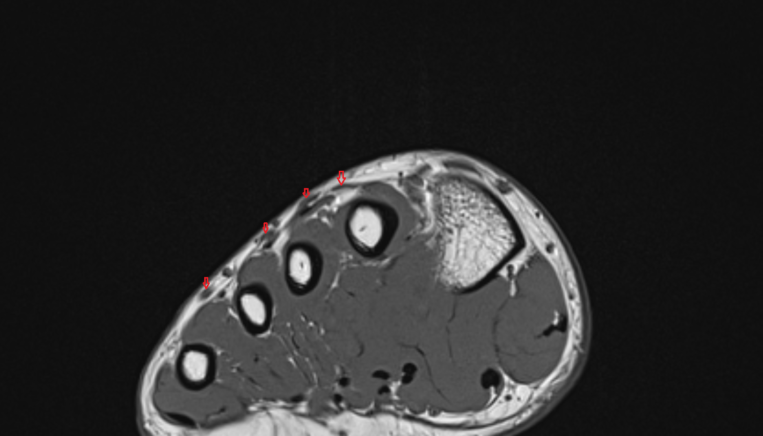 Extensor digitorum longus tendons  of the Foot  axial cross sectional anatomy 3T MRI AI enhanced radiology image-img-00000-00000_00002