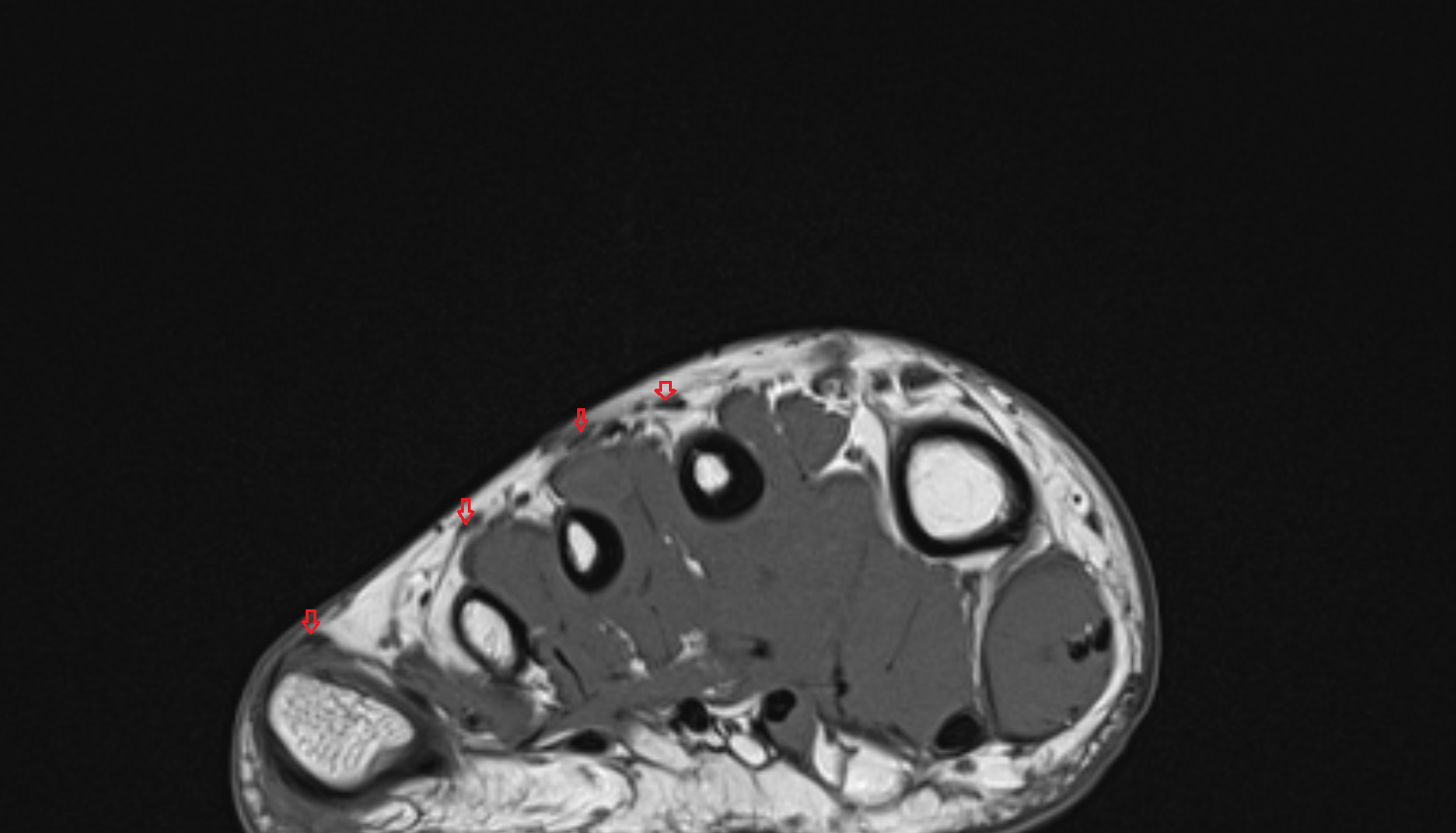 Extensor digitorum longus tendons  of the Foot  axial cross sectional anatomy 3T MRI AI enhanced radiology image-img-00000-00000_00003