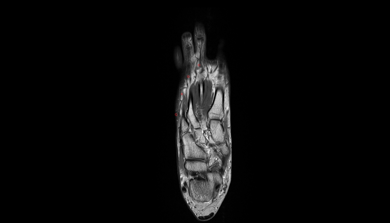 Extensor digitorum longus tendons  of the Foot  axial cross sectional anatomy 3T MRI AI enhanced radiology image-img-00000-00000_00004