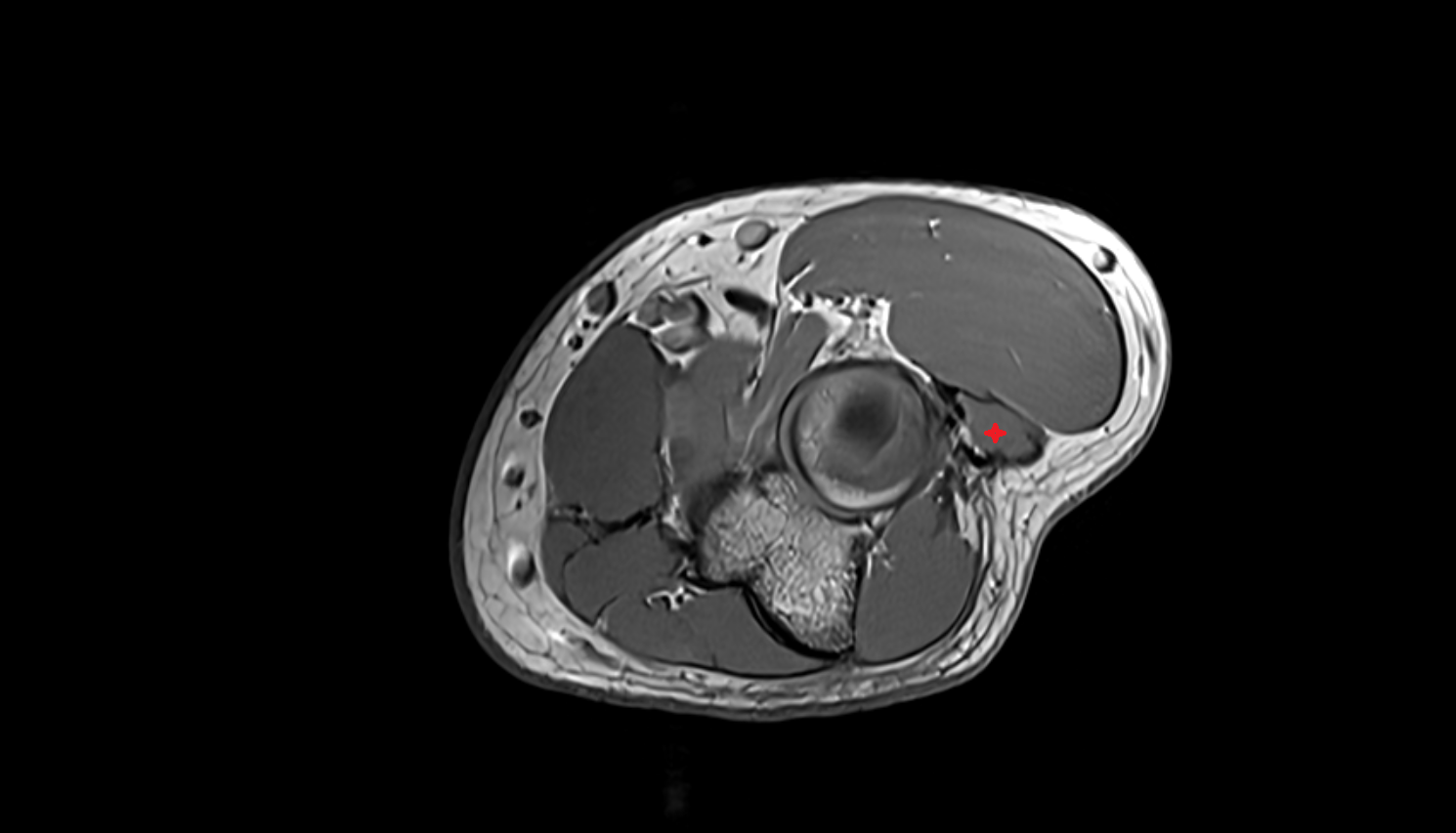 Extensor digitorum muscle  axial cross sectional anatomy 3T MRI AI enhanced radiology image -img-00000-00000