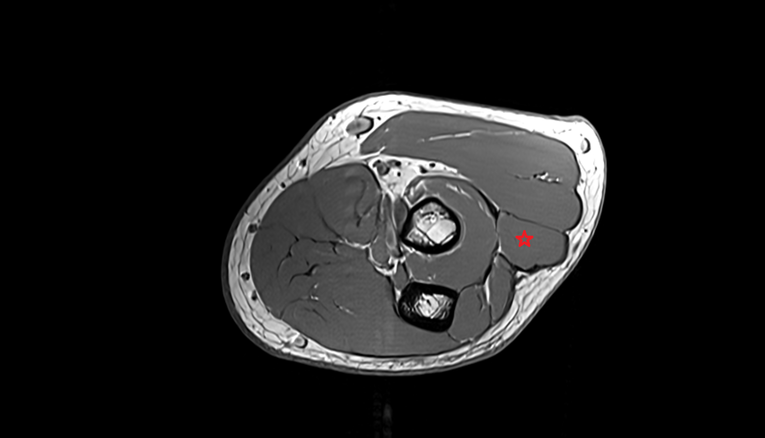 Extensor digitorum muscle  axial cross sectional anatomy 3T MRI AI enhanced radiology image -img-00000-00000_00001