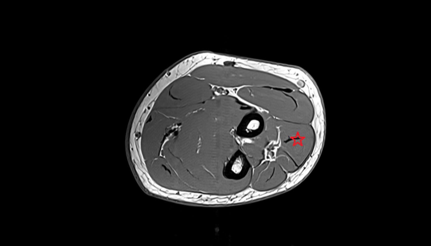Extensor digitorum muscle  axial cross sectional anatomy 3T MRI AI enhanced radiology image -img-00000-00000_00002