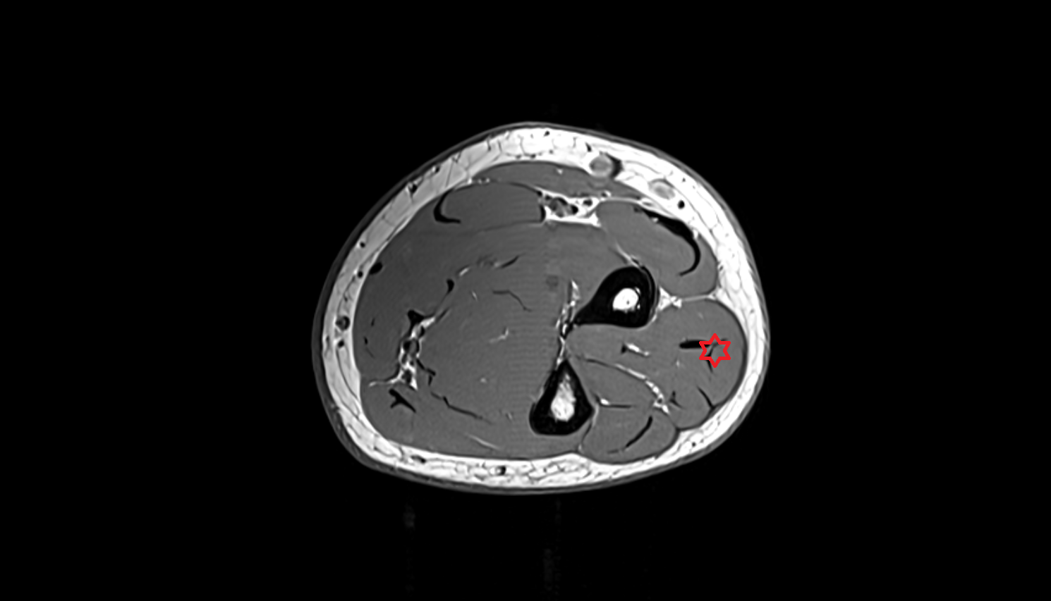 Extensor digitorum muscle  axial cross sectional anatomy 3T MRI AI enhanced radiology image -img-00000-00000_00003