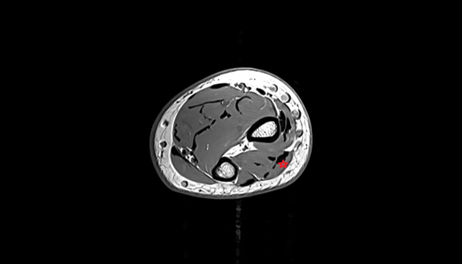 Extensor digitorum muscle  axial cross sectional anatomy 3T MRI AI enhanced radiology image -img-00000-00000_00004