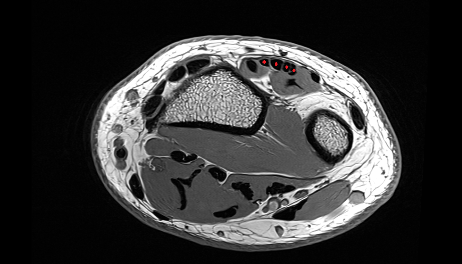 Extensor digitorum tendons axial cross sectional anatomy 3T MRI AI enhanced radiology image-img-00000-00000