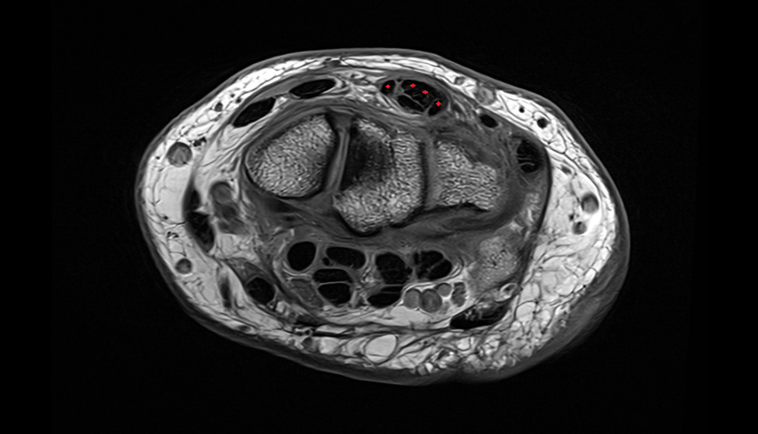 Extensor digitorum tendons axial cross sectional anatomy 3T MRI AI enhanced radiology image-img-00000-00000_00001