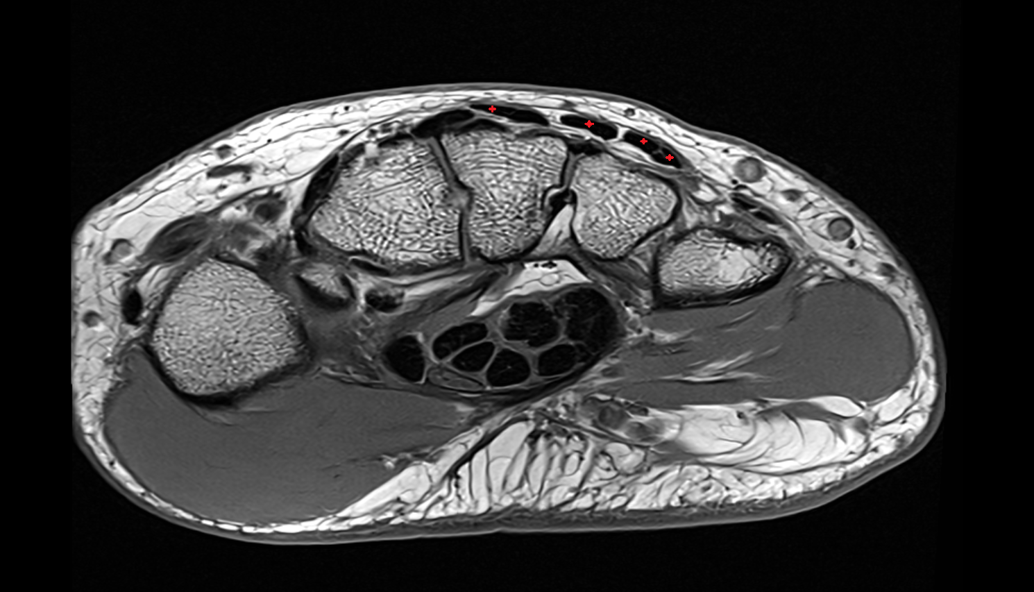 Extensor digitorum tendons axial cross sectional anatomy 3T MRI AI enhanced radiology image-img-00000-00000_00002