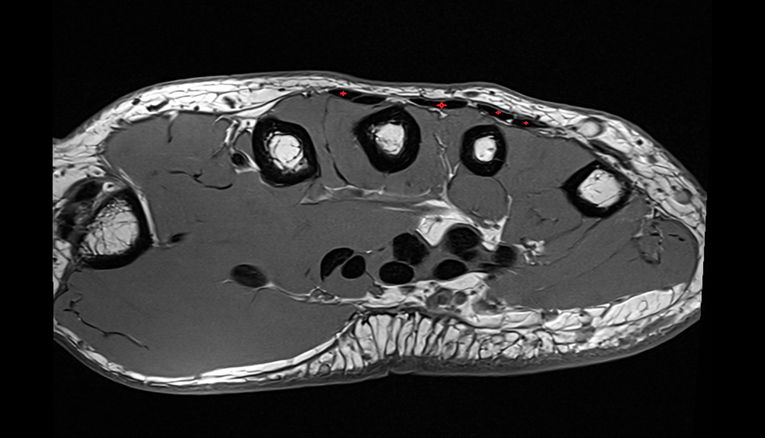 Extensor digitorum tendons axial cross sectional anatomy 3T MRI AI enhanced radiology image-img-00000-00000_00003
