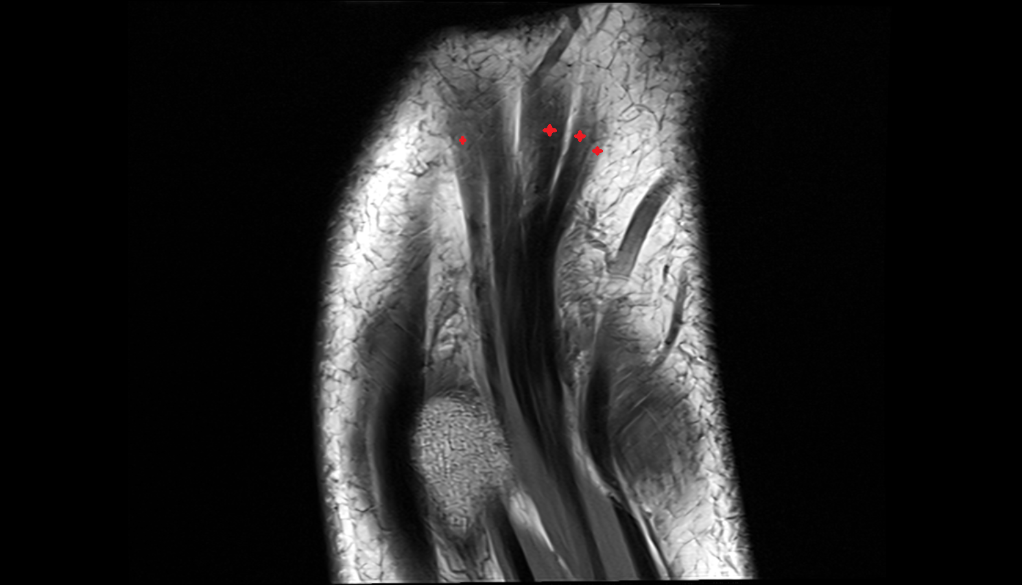 Extensor digitorum tendons coronal cross sectional anatomy 3T MRI AI enhanced radiology image-img-00000-00000