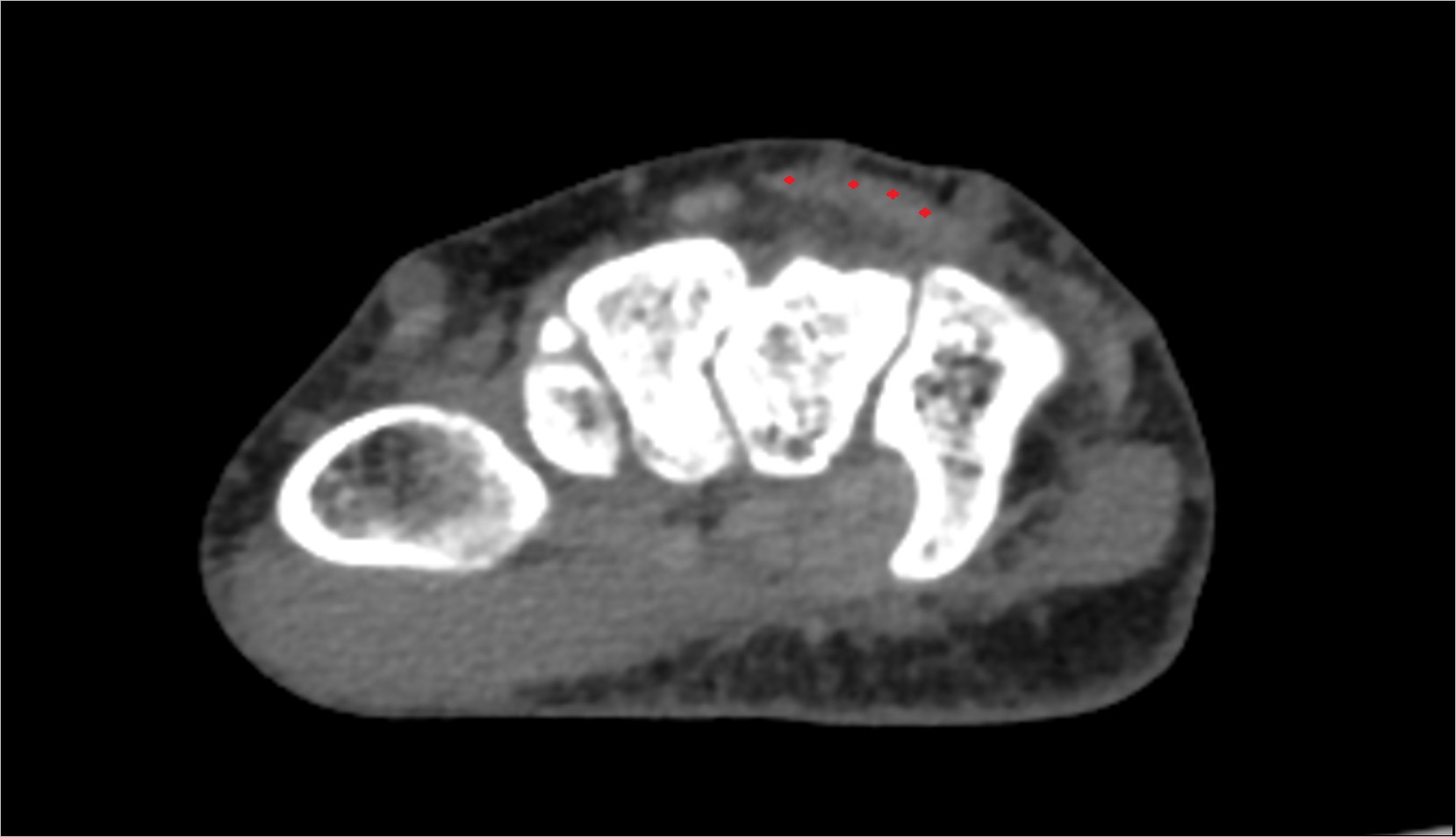 Extensor digitorum tendons ct axial