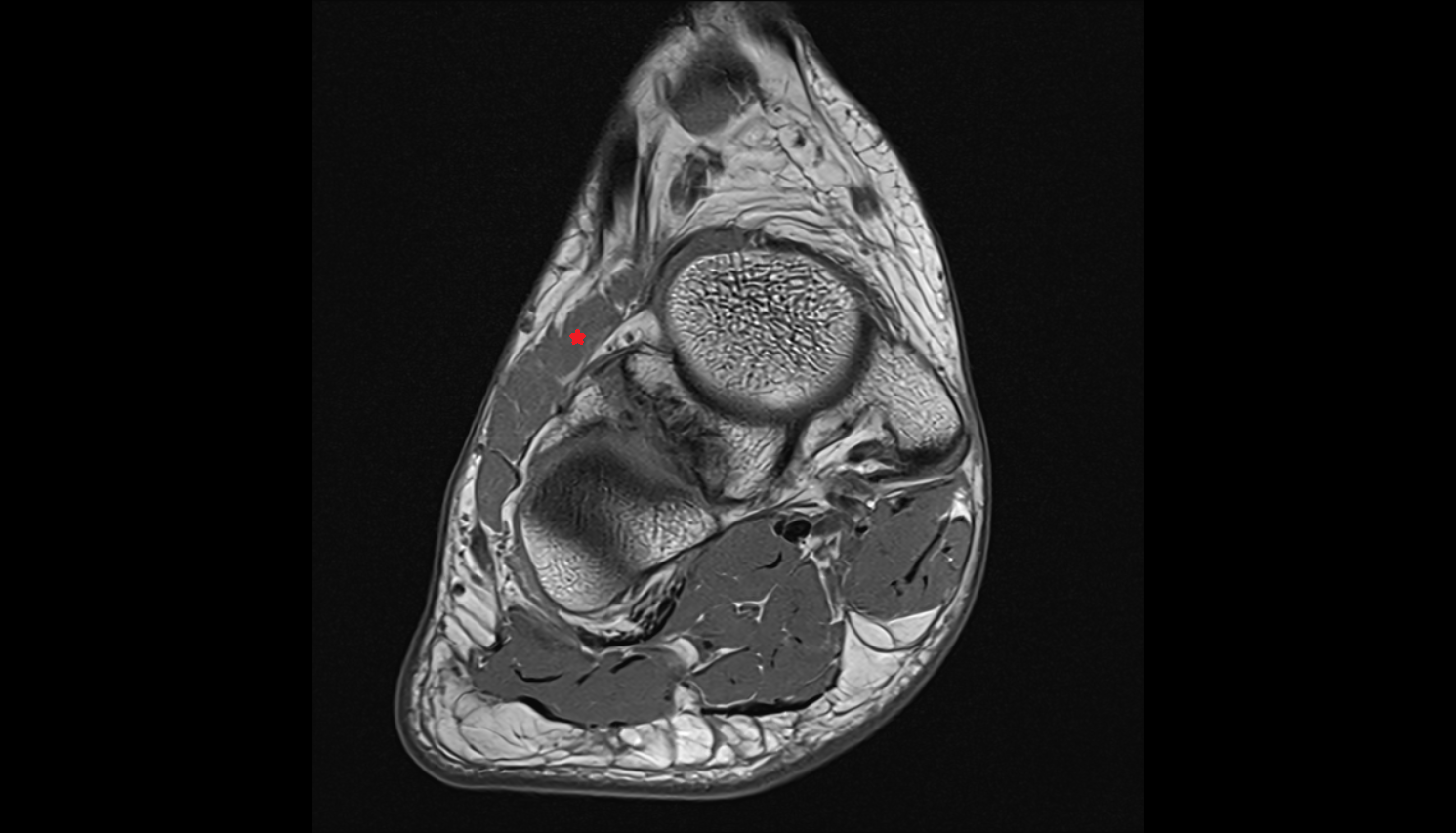 Extensor hallucis brevis muscle  axial cross sectional anatomy 3T MRI AI enhanced radiology image-img-00000-00000