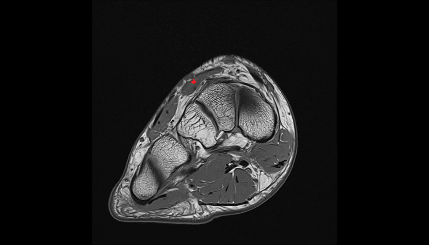 Extensor hallucis brevis muscle  axial cross sectional anatomy 3T MRI AI enhanced radiology image-img-00000-00000_00002