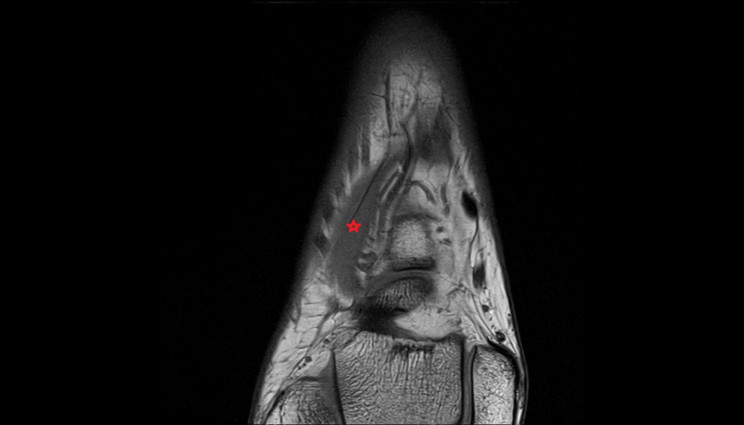 Extensor hallucis brevis muscle  coronal cross sectional anatomy 3T MRI AI enhanced radiology image-img-00000-00000