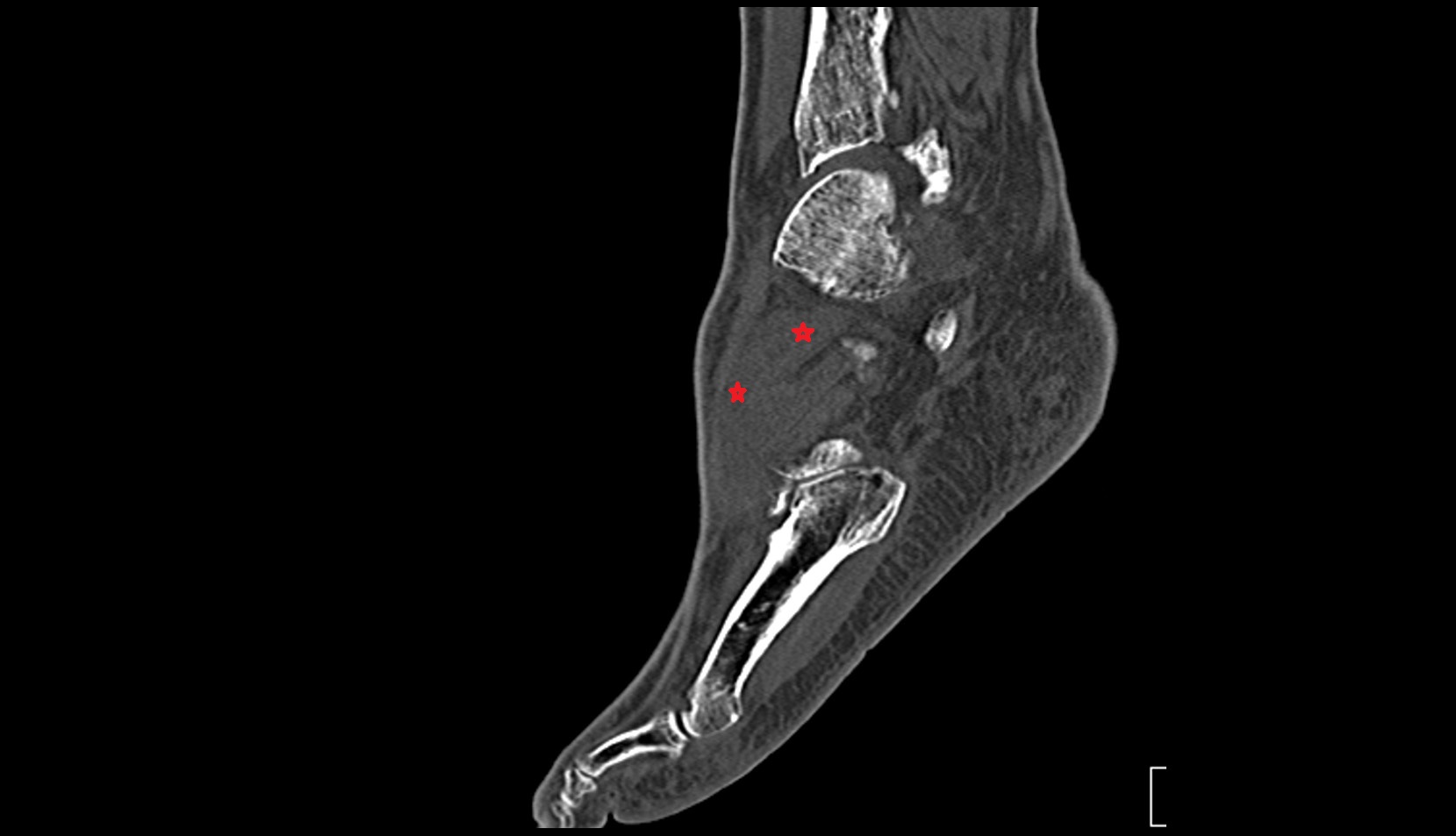 Extensor hallucis brevis muscle satital ct image