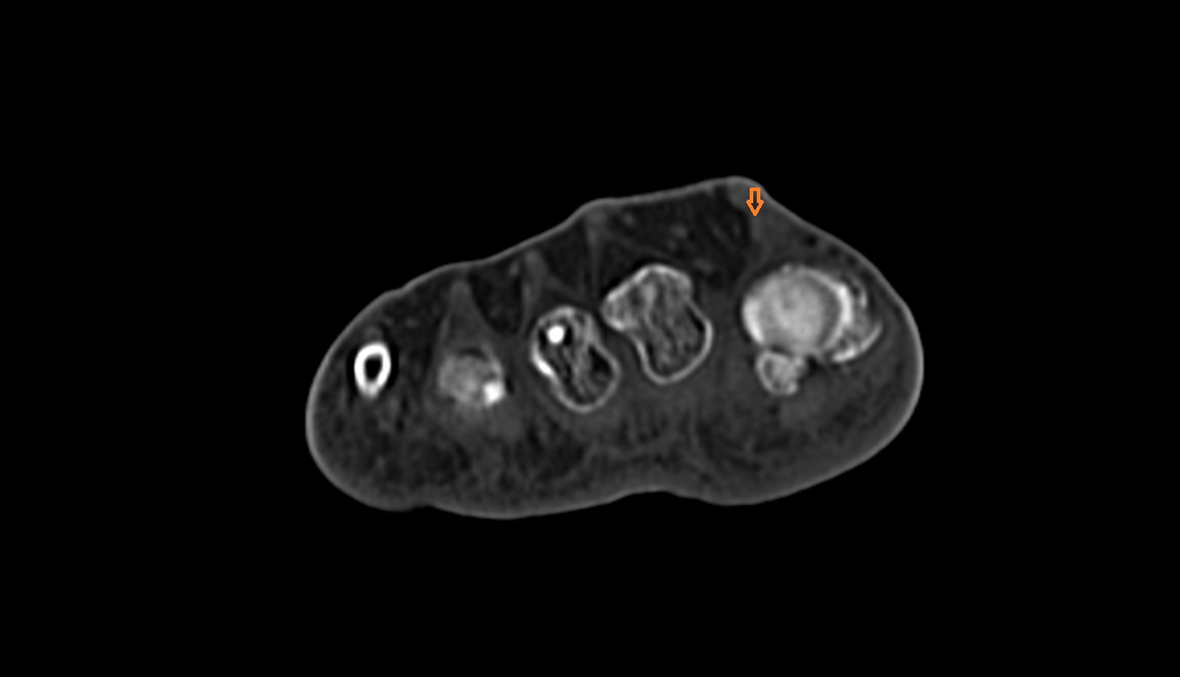 Extensor hallucis brevis tendon ct axial