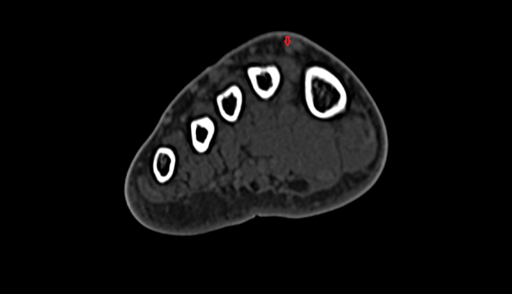 Extensor hallucis brevis tendon ct axial 1