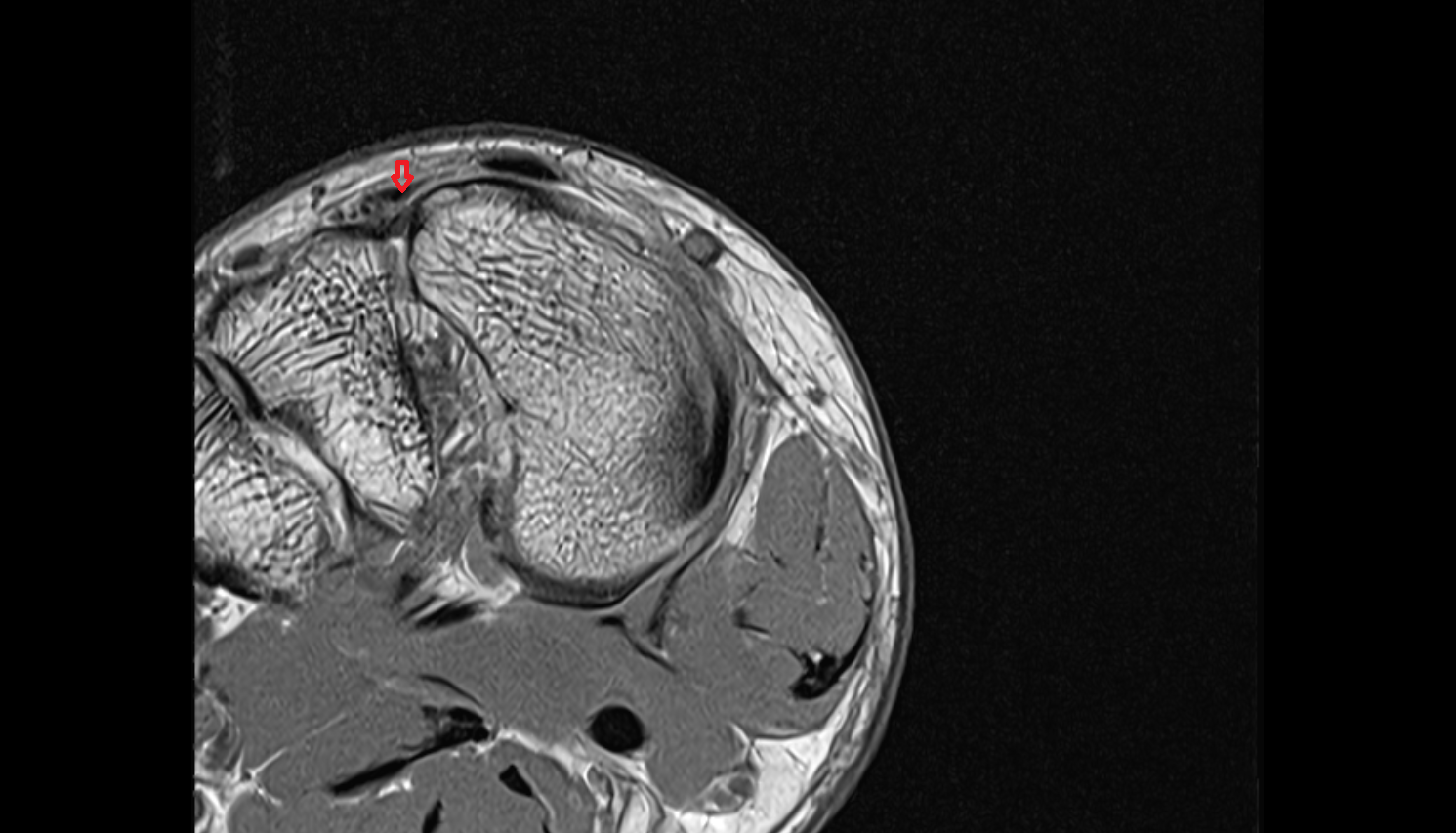 Extensor hallucis brevis tendon of the Foot  axial cross sectional anatomy 3T MRI AI enhanced radiology image-img-00000-00000