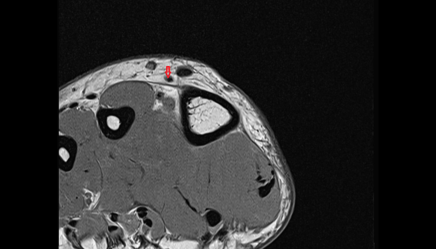 Extensor hallucis brevis tendon of the Foot  axial cross sectional anatomy 3T MRI AI enhanced radiology image-img-00000-00000_00001