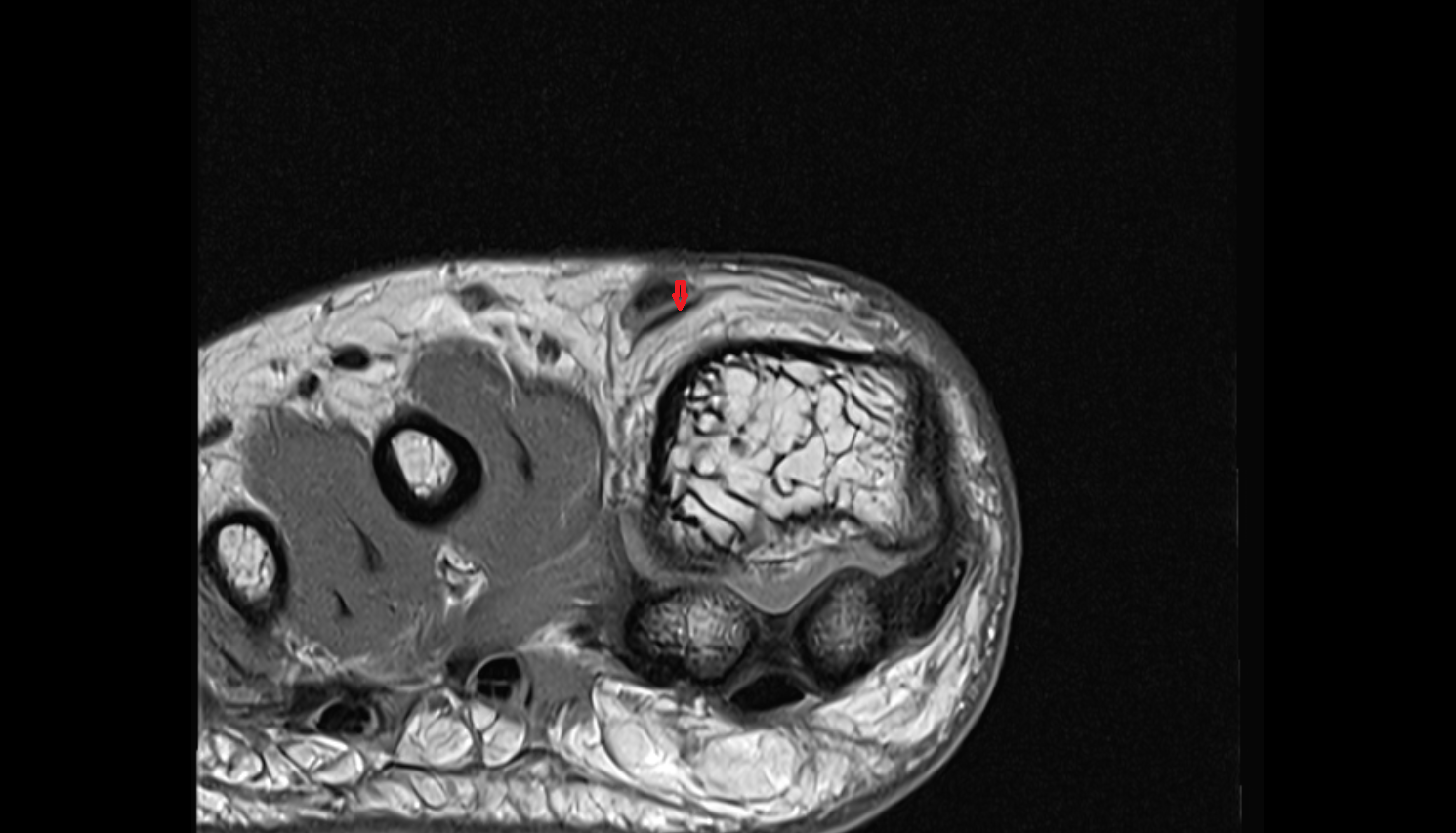 Extensor hallucis brevis tendon of the Foot  axial cross sectional anatomy 3T MRI AI enhanced radiology image-img-00000-00000_00002