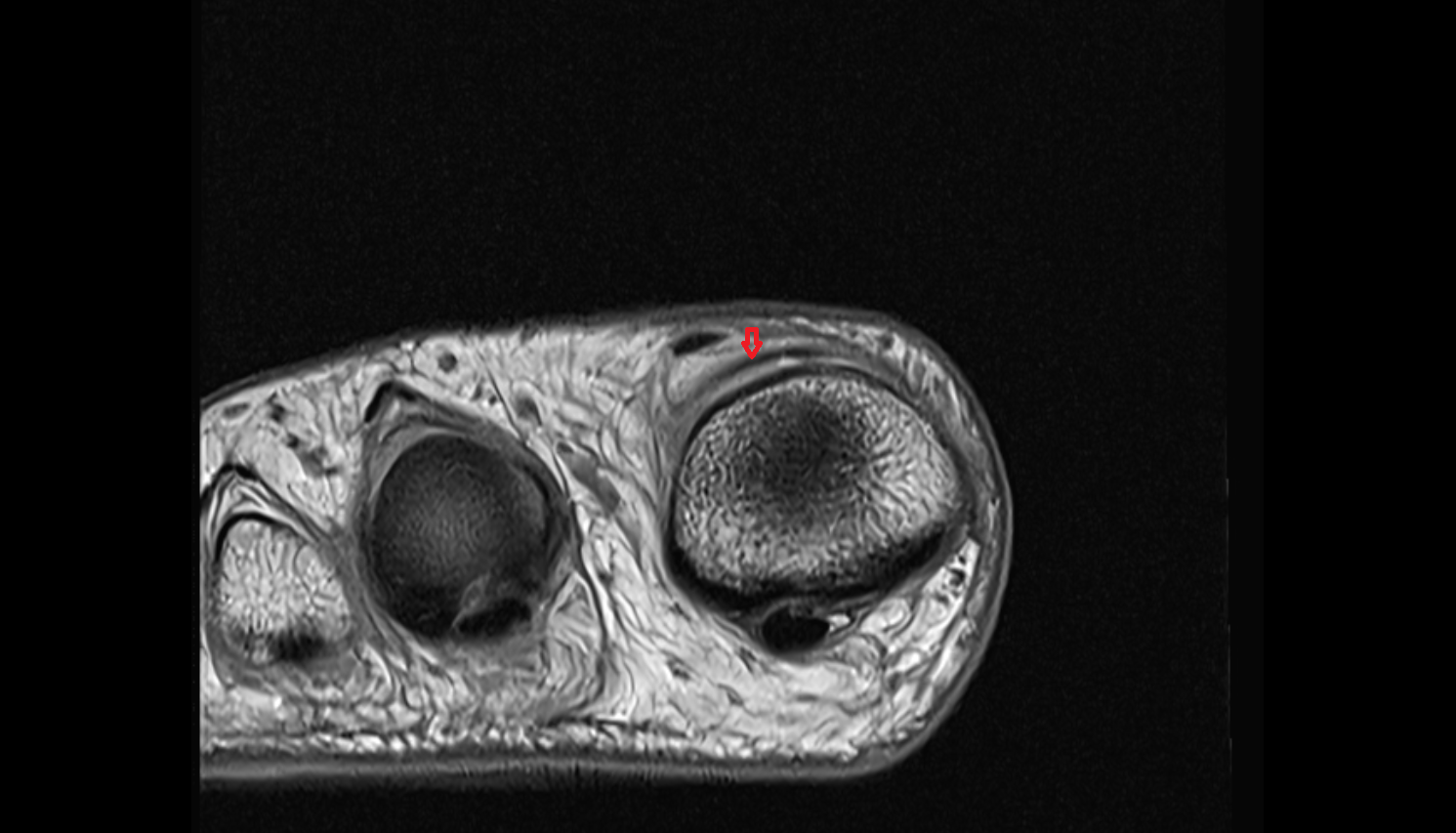 Extensor hallucis brevis tendon of the Foot  axial cross sectional anatomy 3T MRI AI enhanced radiology image