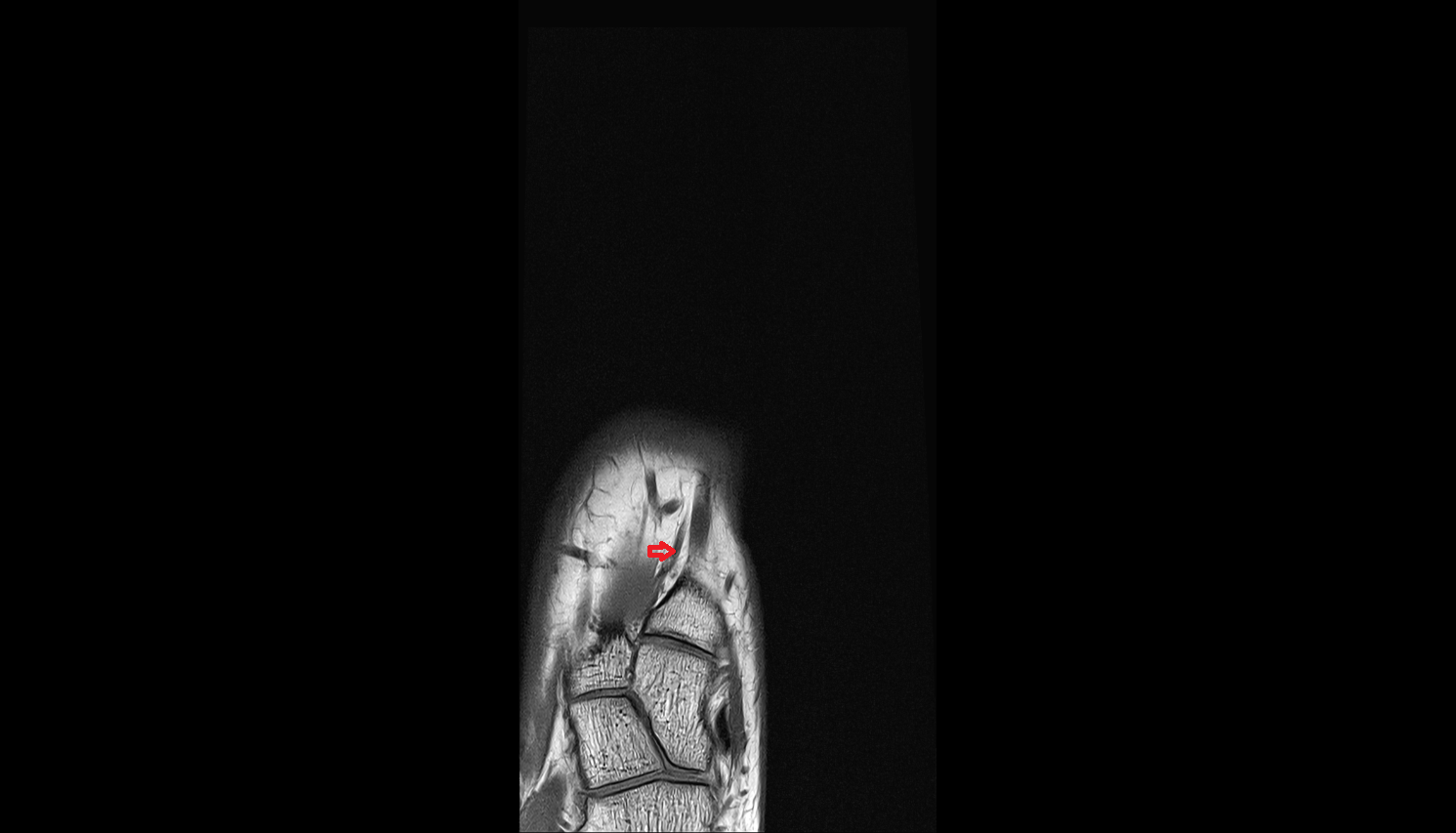 Extensor hallucis brevis tendon of the Foot  coronal cross sectional anatomy 3T MRI AI enhanced radiology image