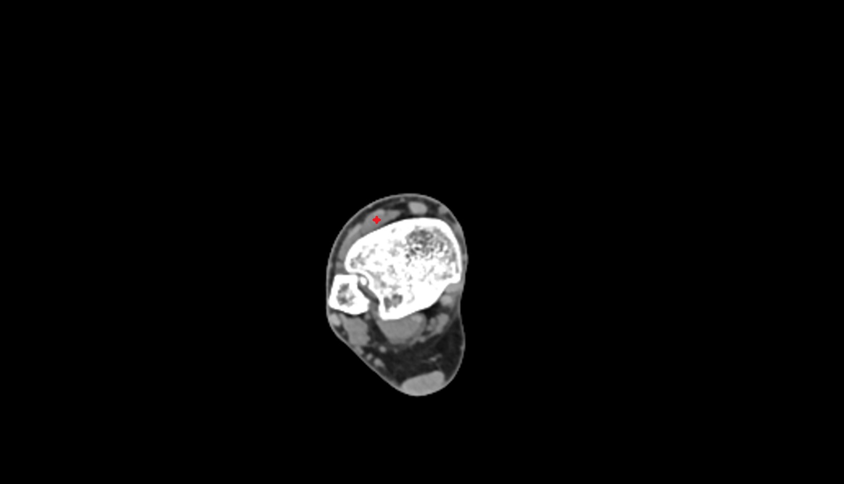 Extensor hallucis longus axial ct image