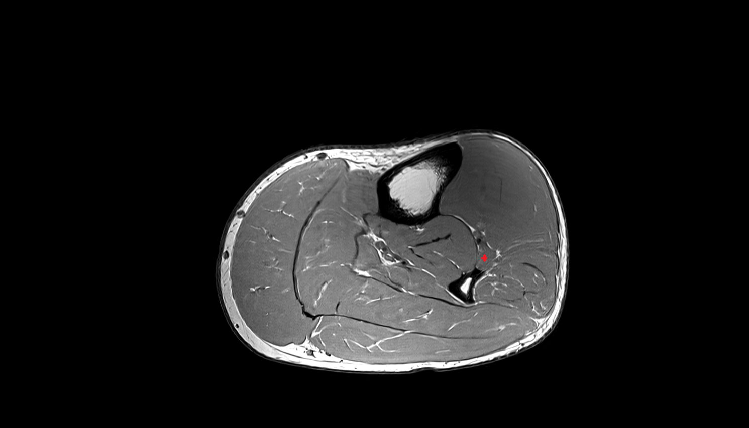 Extensor hallucis longus muscle   MRI axial  cross sectional anatomy 3T MRI AI enhanced radiology image-img-00000-00000