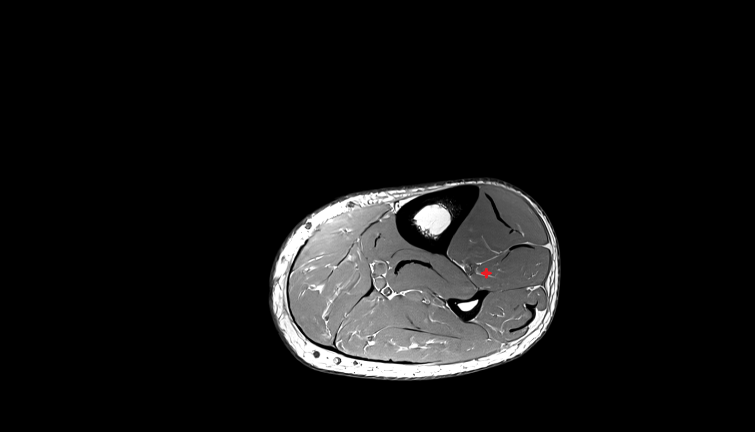 Extensor hallucis longus muscle   MRI axial  cross sectional anatomy 3T MRI AI enhanced radiology image-img-00000-00000_00001