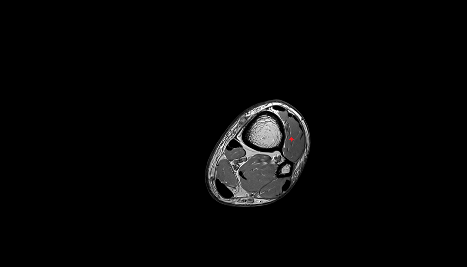 Extensor hallucis longus muscle   MRI axial  cross sectional anatomy 3T MRI AI enhanced radiology image-img-00000-00000_00002