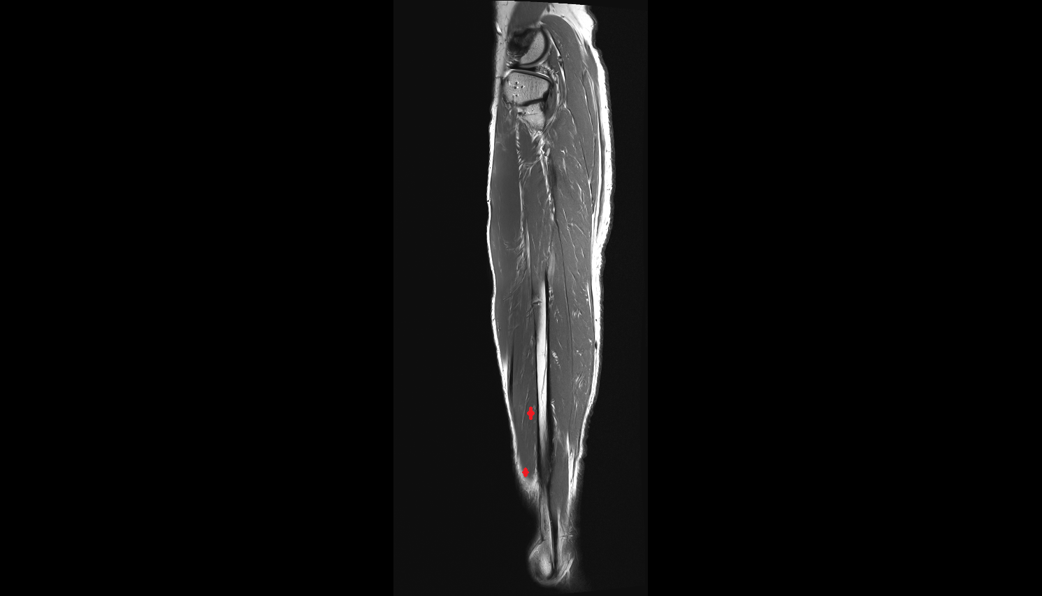 Extensor hallucis longus muscle   MRI sag  cross sectional anatomy 3T MRI AI enhanced radiology image-img-00000-00000