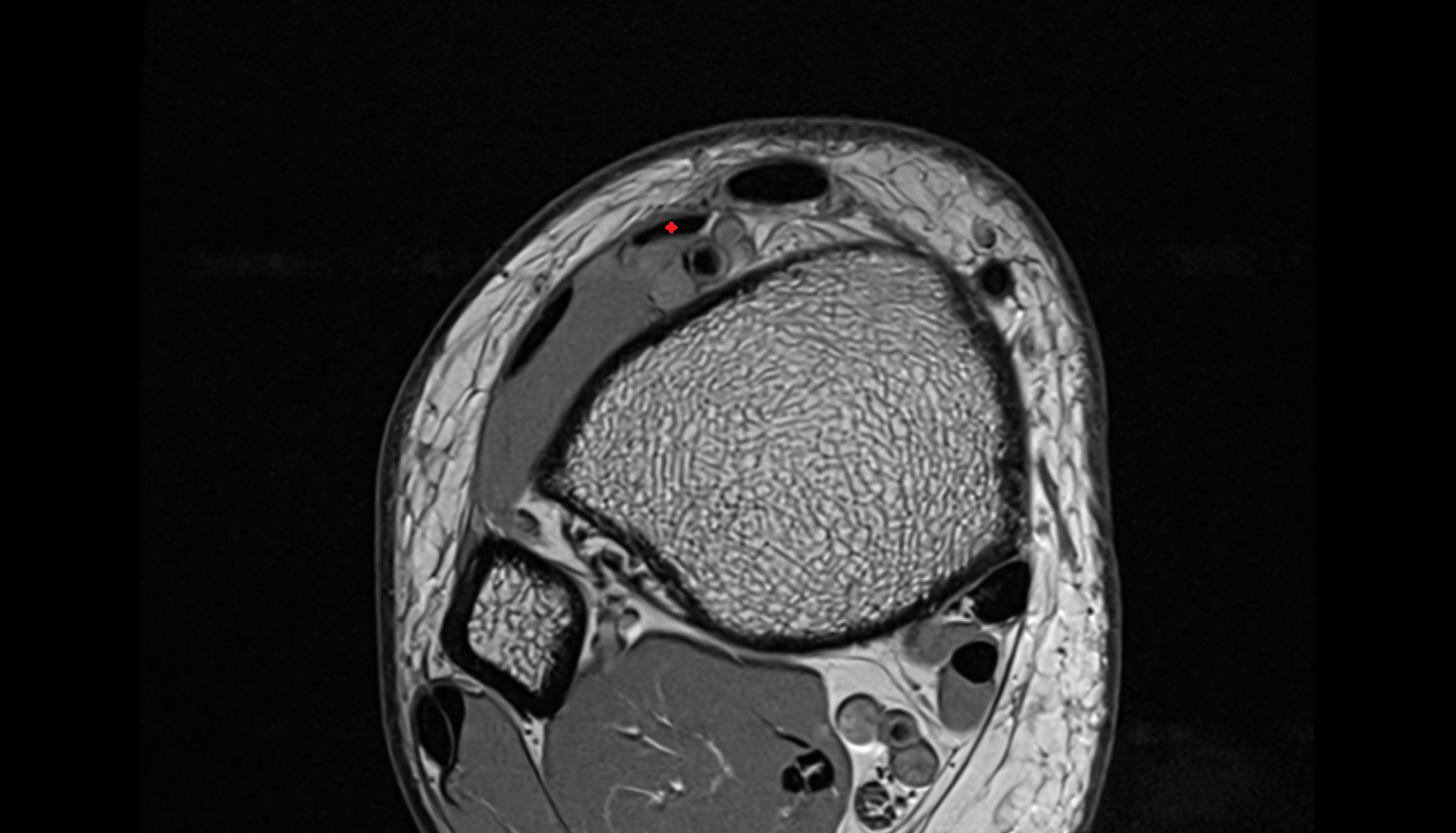 Extensor hallucis longus tendon  axial cross sectional anatomy 3T MRI AI enhanced radiology image-img-00000-00000