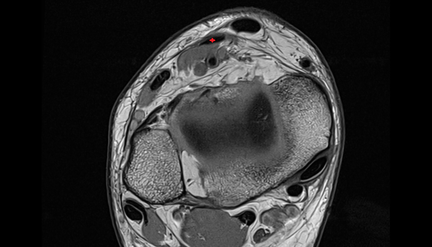 Extensor hallucis longus tendon  axial cross sectional anatomy 3T MRI AI enhanced radiology image-img-00000-00000_00001