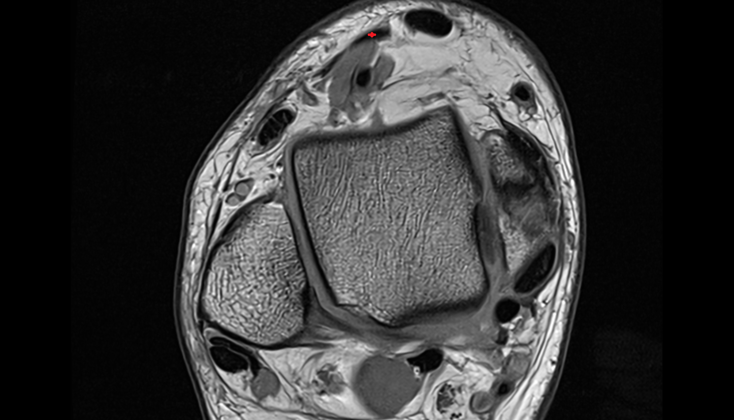 Extensor hallucis longus tendon  axial cross sectional anatomy 3T MRI AI enhanced radiology image-img-00000-00000_00002