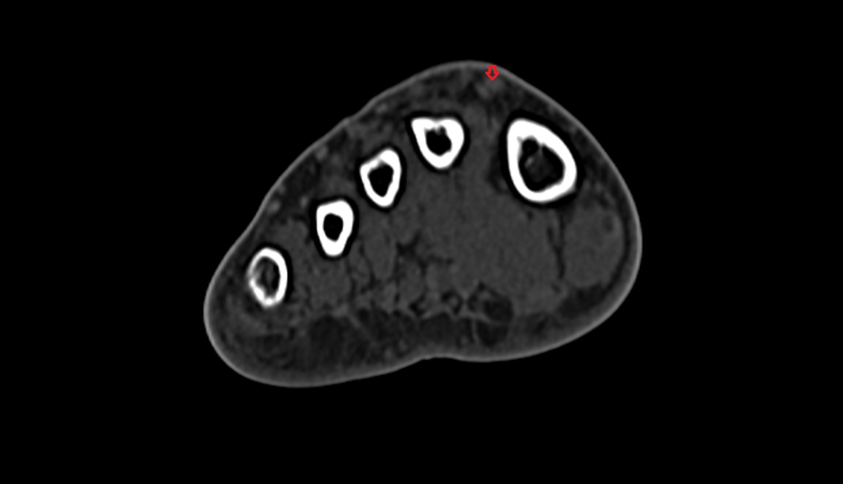 Extensor hallucis longus tendon ct axial