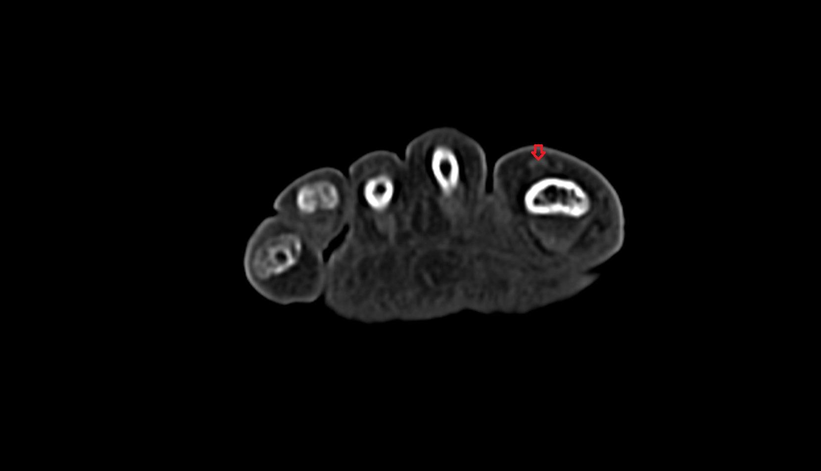 Extensor hallucis longus tendon ct axial 1