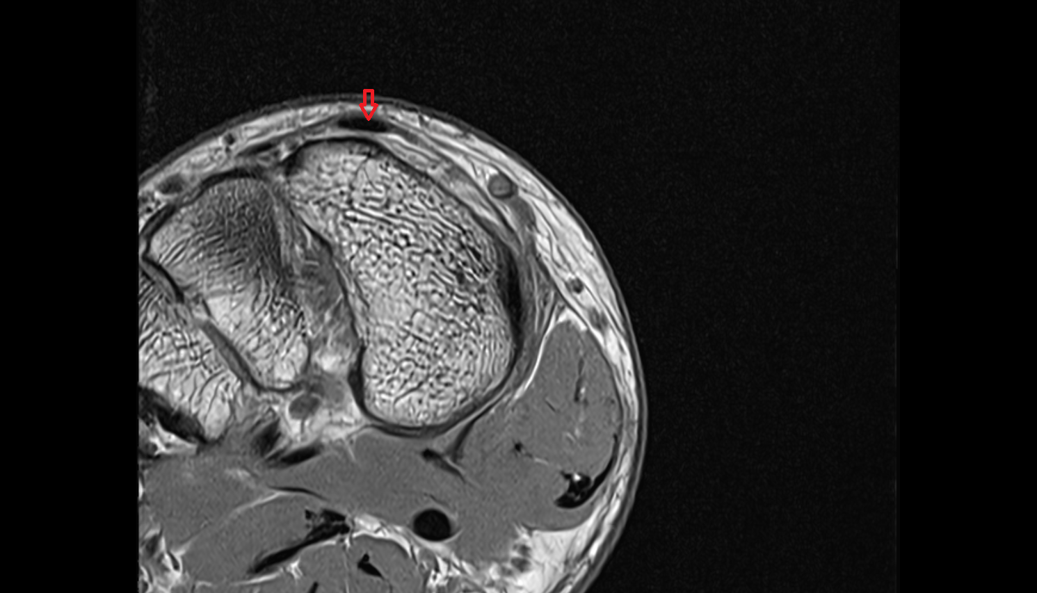 Extensor hallucis longus tendon of the Foot  axial cross sectional anatomy 3T MRI AI enhanced radiology image-img-00000-00000_00000