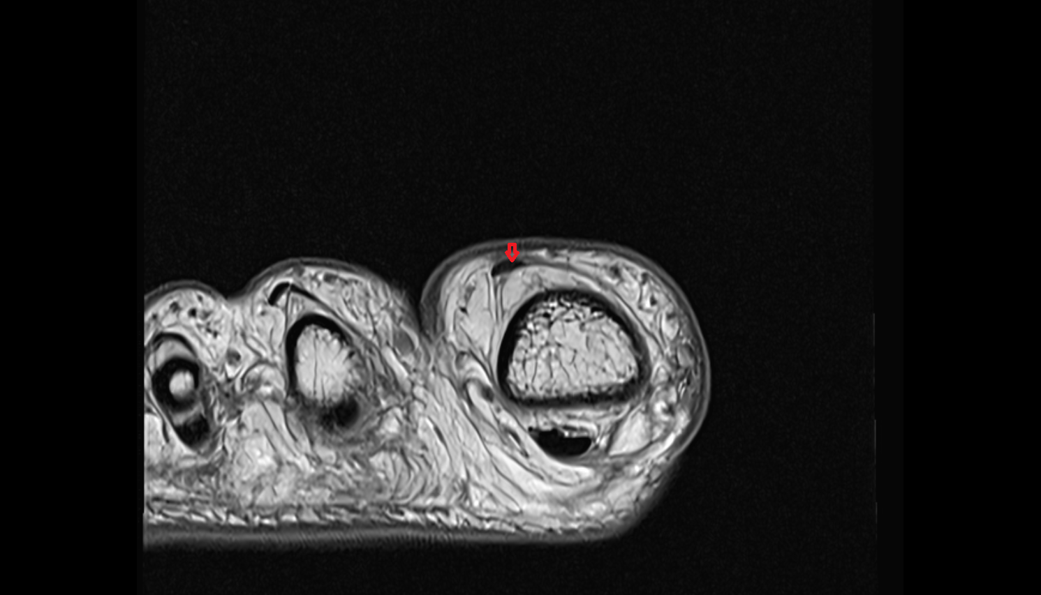 Extensor hallucis longus tendon of the Foot  axial cross sectional anatomy 3T MRI AI enhanced radiology image-img-00000-00000_0002