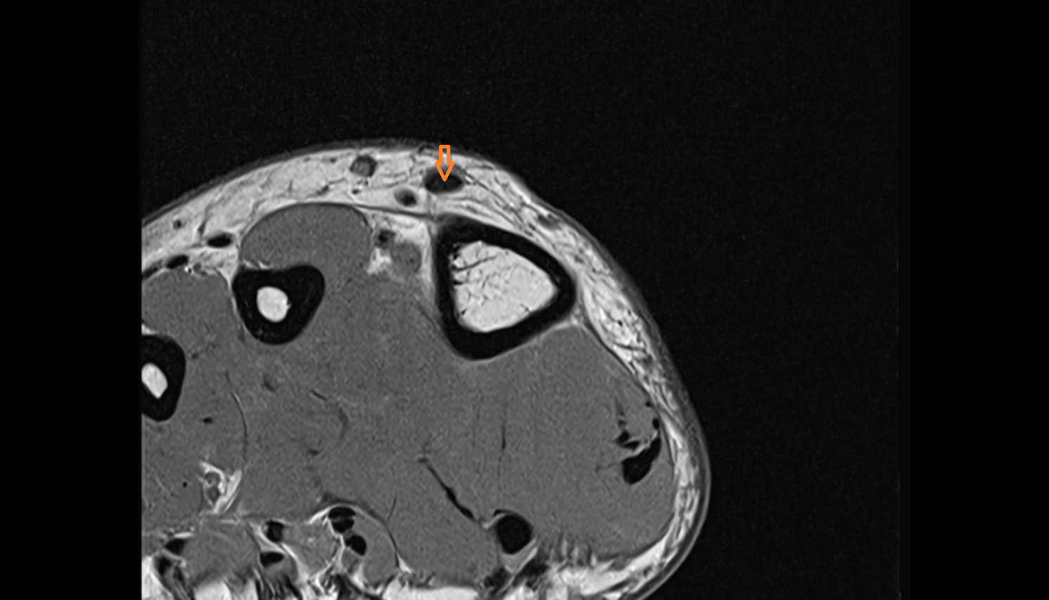 Extensor hallucis longus tendon of the Foot  axial cross sectional anatomy 3T MRI AI enhanced radiology image-img-00000-00001