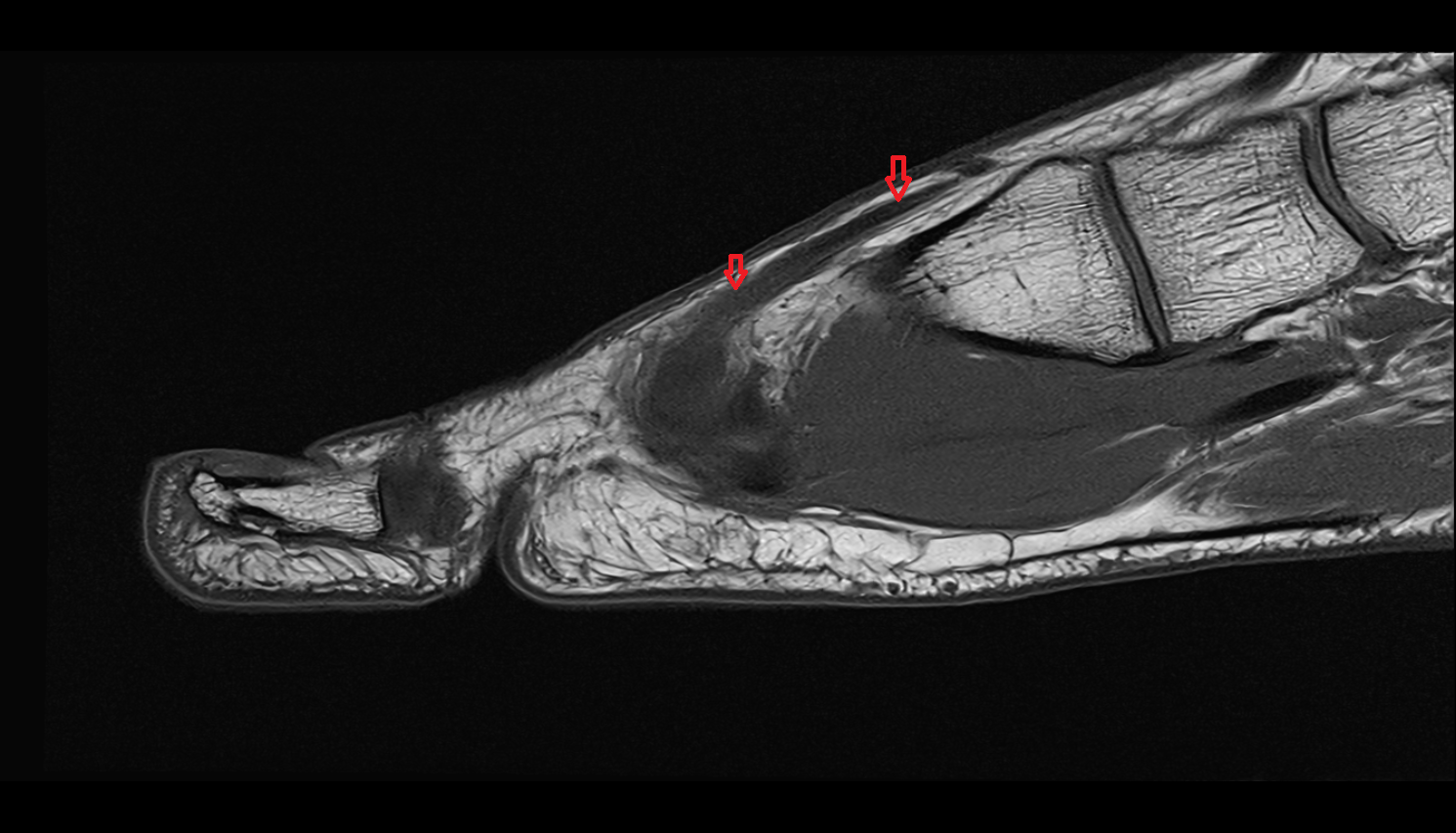Extensor hallucis longus tendon of the Foot  sag cross sectional anatomy 3T MRI AI enhanced radiology image-img-00000-00000