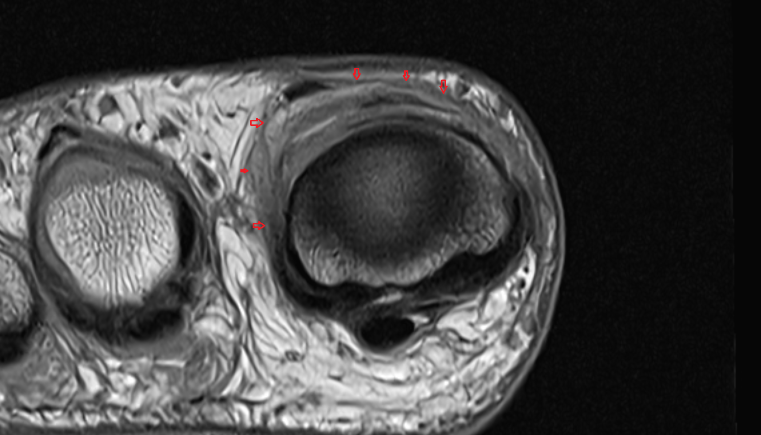 Extensor hood of foot axial cross sectional anatomy 3T MRI AI enhanced radiology image-img-00000-00000