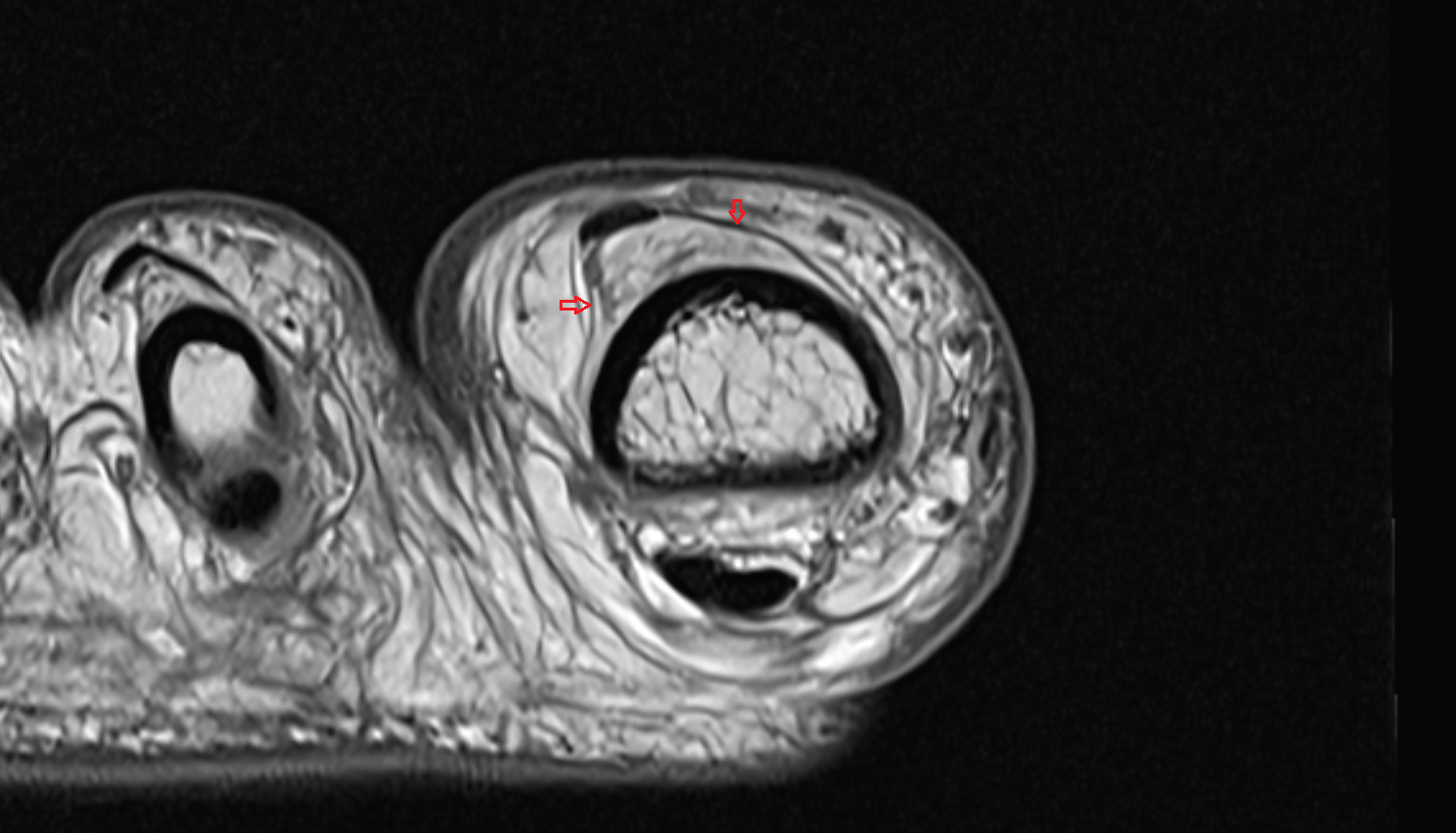 Extensor hood of foot axial cross sectional anatomy 3T MRI AI enhanced radiology image-img-00000-00000_00001