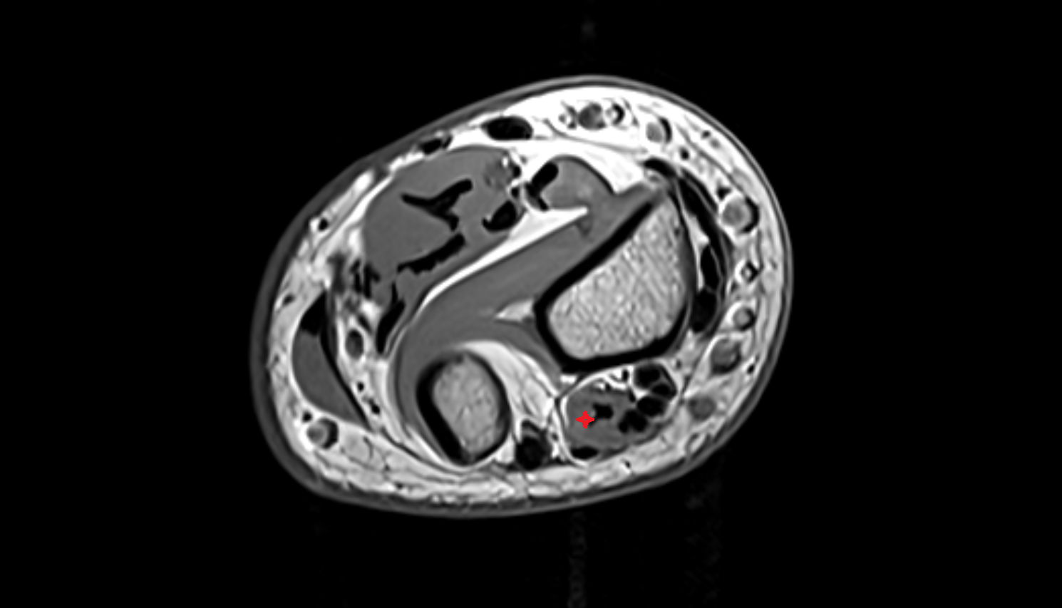 Extensor indicis muscle axial cross sectional anatomy 3T MRI AI enhanced radiology image-img-00000-00000